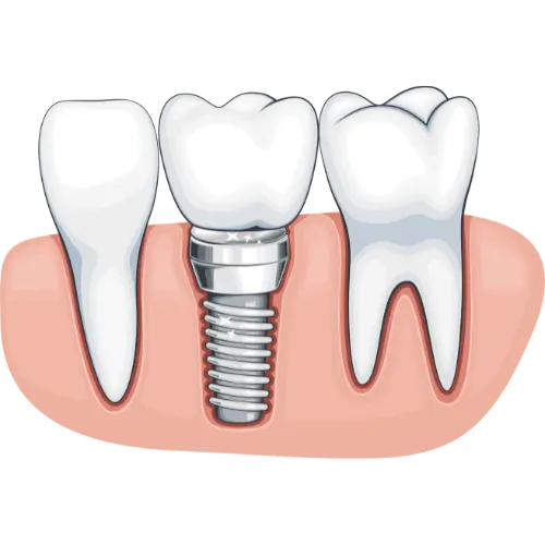 Goldstream Dental - Implant Image